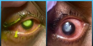 woman, cornea, bacteria, doctor, patient, habit, sleeping, Contact Lenses, eye,