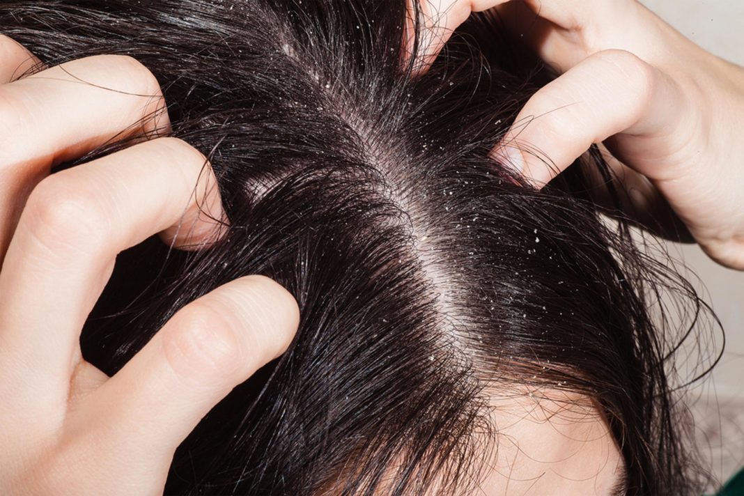 HAIR LOSS OR HAIR THINNING, HAIR BREAKAGE, DRY AND BRITTLE, ITCHY SCALP, TURNING GREY PREMATURELY, SLOW HAIR GROWTH,