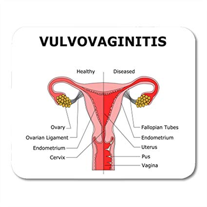 SEXUALLY TRANSMITTED DISEASES, VULVOVAGINITIS, OVARIAN CYSTS, PELVIC INFLAMMATORY DISEASE, ENDOMETRIOSIS AND ADENOMYOSIS, OVARIAN CANCER, 