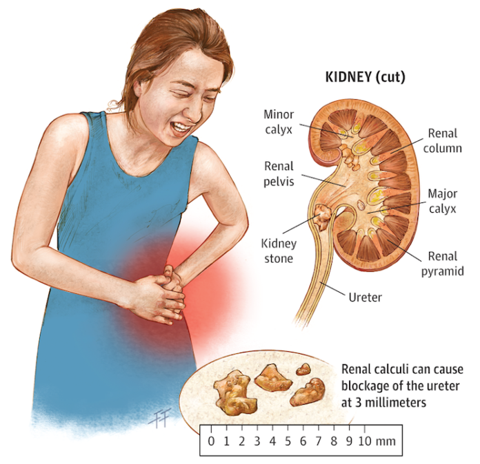 Kidney Damage, Signs Of Kidney Damage , kidney failure, Tiredness, Breathlessness