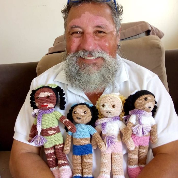 Grandfather, Crochets Dolls , Vitiligo , Children , sharp margins, pigment, 