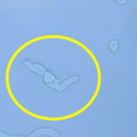 Eye-Floaters-Pictures