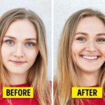 Creation-of dimples-on-cheeks