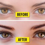 Eyebrow-and-Eyelash-Hair-Transplantation