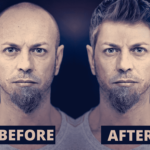 Hair-transplantation