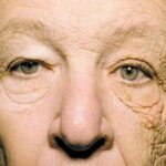 Wrinkles-are-related-to-heart-illness.