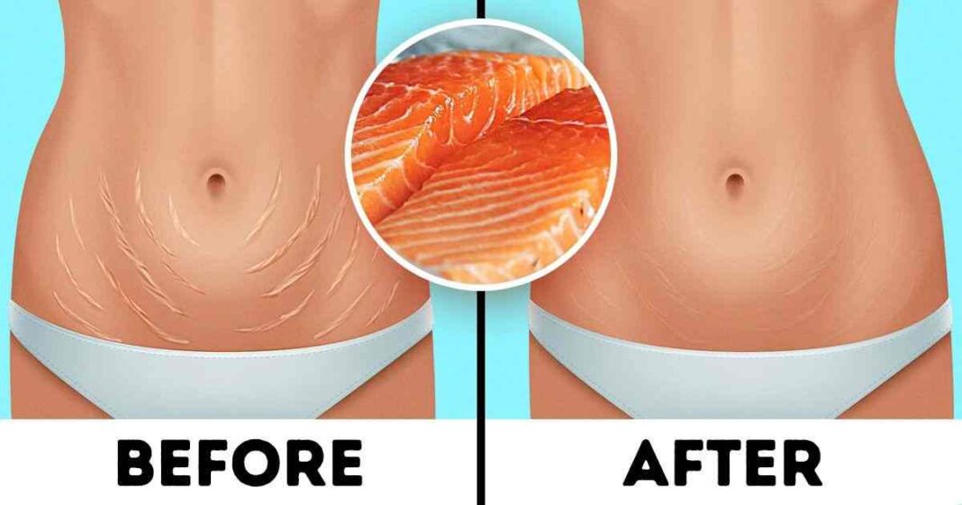 6 Ways to Make Your Stretch Marks Less Visible