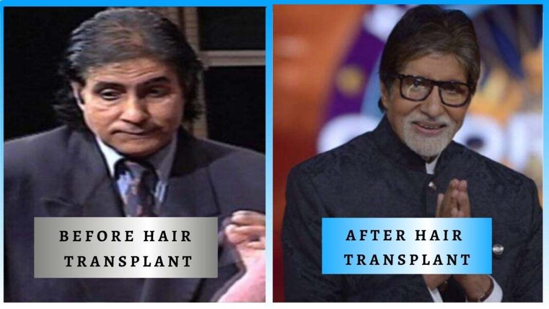 5 Bollywood Celebrities Whose Career Changed After Getting Hair Transplant