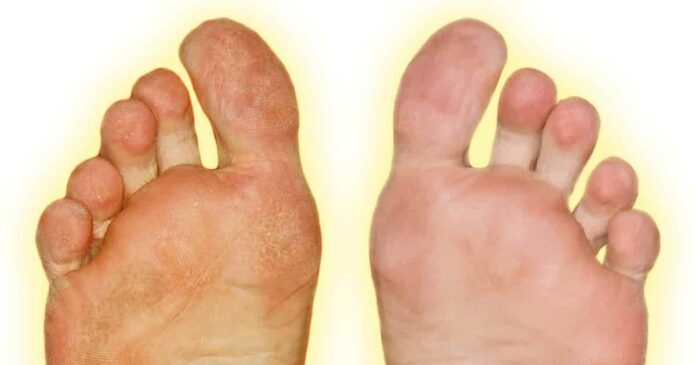 10 Quick Ways to Remove Calluses and Get Baby-Soft Feet