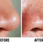 clogged-pores-and-breakouts