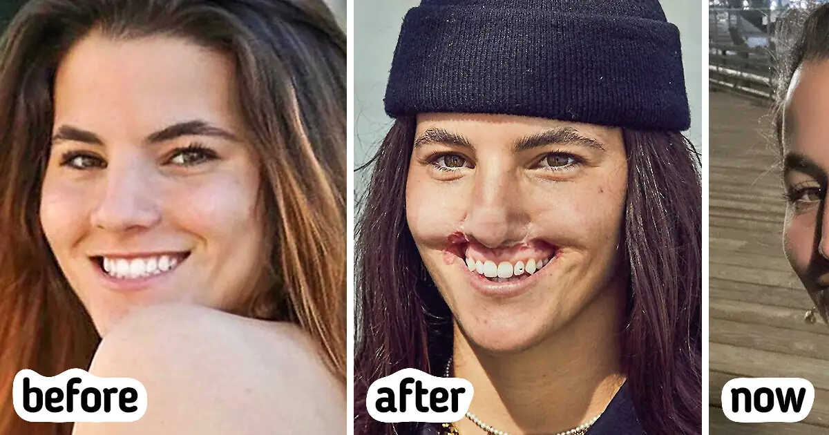 The Model Got Mauled By A Dog, And Her Journey To Embrace A New Look Is A Testament To Courage