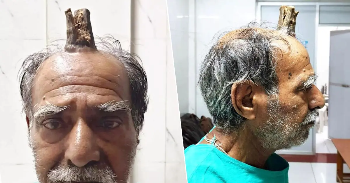 Man’s Horror As Four-inch ‘Devil Horn’ Grows Out Of His Head