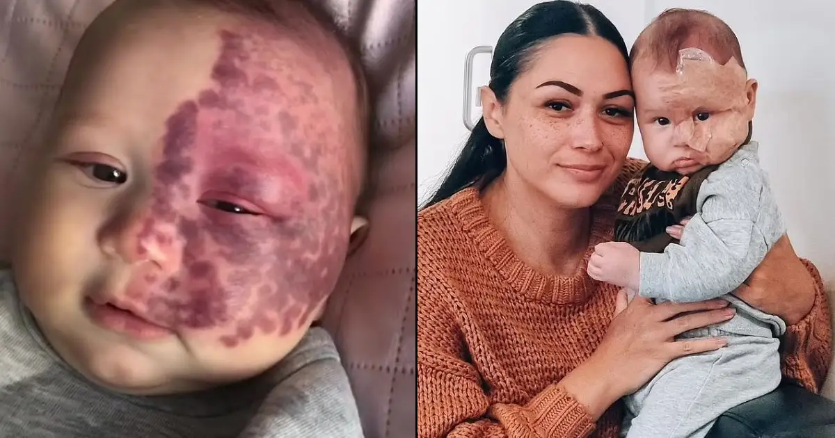 Mom Is Criticized By Followers After Removing Baby’s Birthmark With Laser Treatment